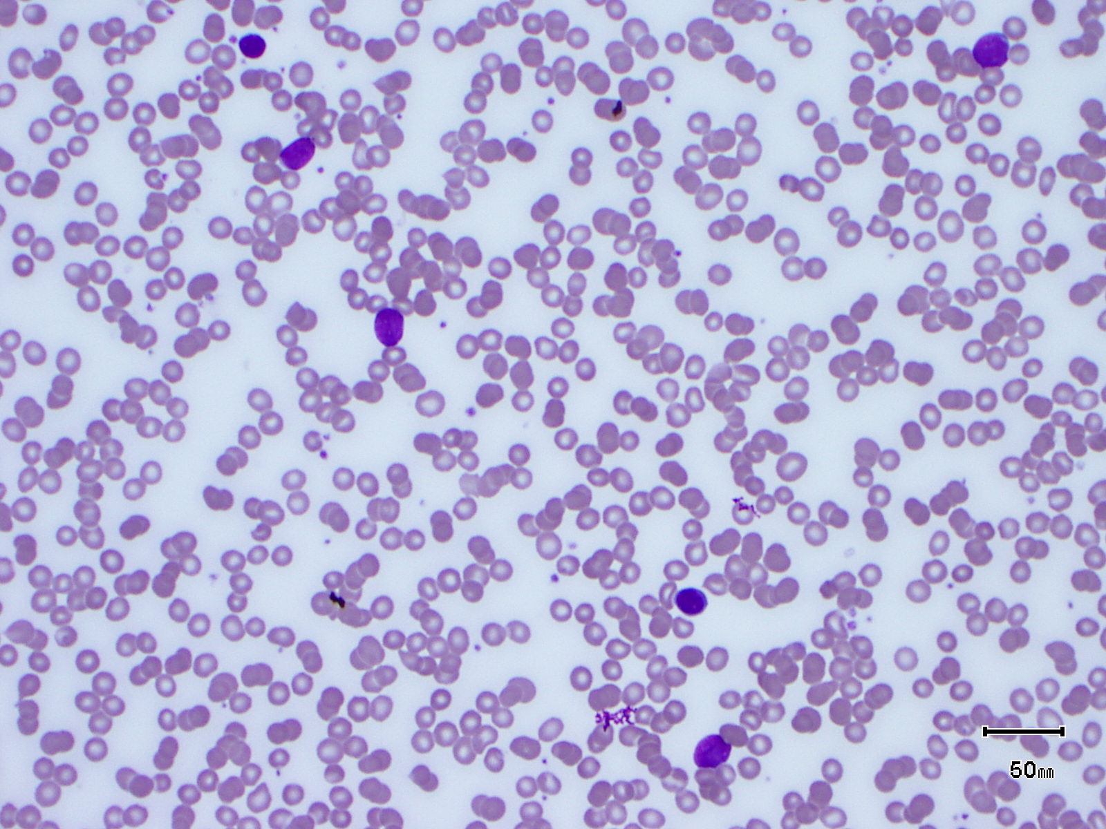 Picture of lymphocytes, a white blood cell, which can be affected by blood cancer
