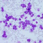Picture of acute myeloid leukaemia blast cells