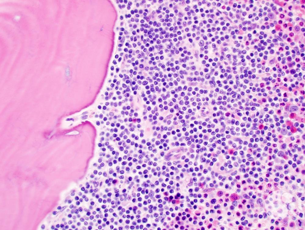 Follicular lymphoma bone marrow cells under the microscope.