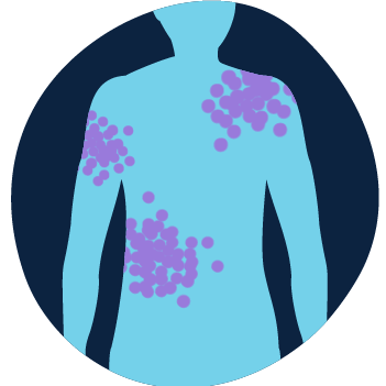 Illustration of a body with little purple dots in particular areas