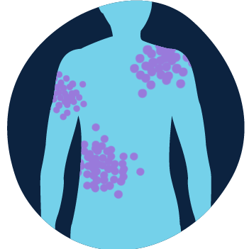 Illustration of a body with little purple dots in particular areas