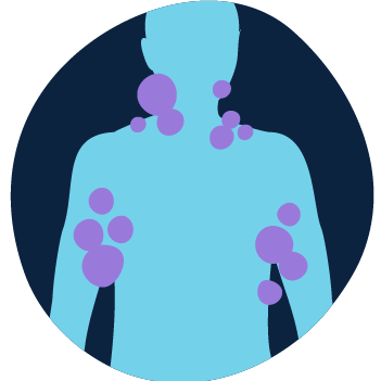 Illustration of a person's body with lymph node areas (under the arms and in the neck) highlighted