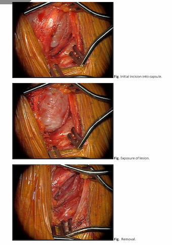 Graeme Ardern's nerve sheath tumour