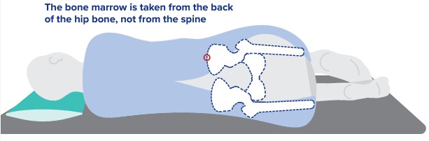 The bone marrow is taken from the back of the hip bone, not from the spine